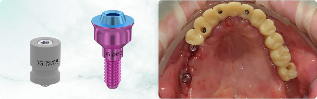 Teeth extraction and implantation for immediate loading