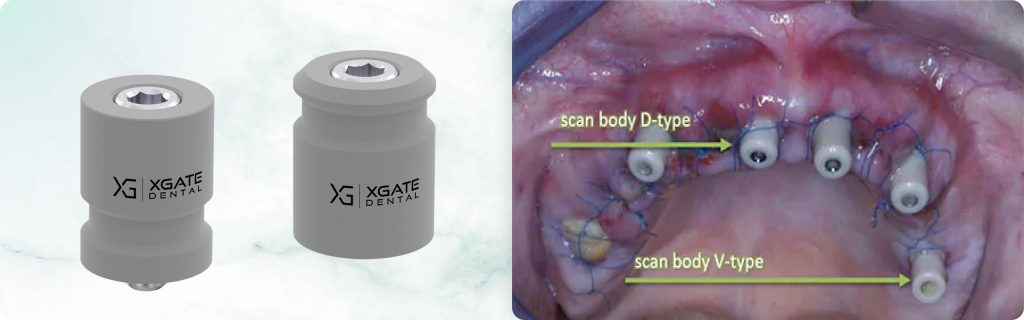 Immediate loading on Multi-unit abutments