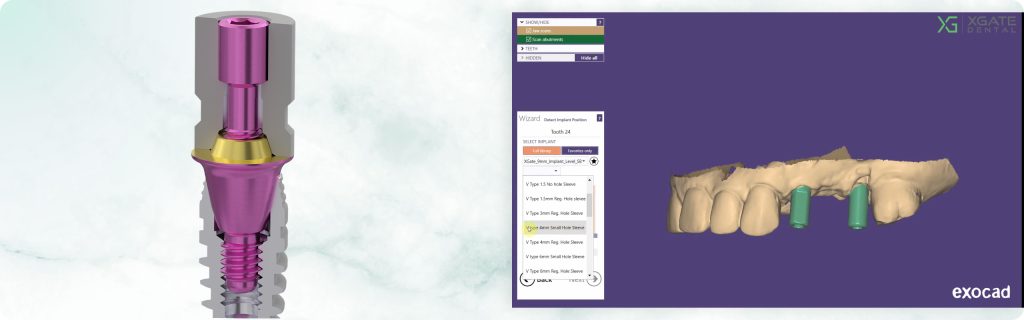 How to work with exocad® library. Multi unit V-type