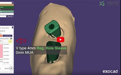 Choosing between regular and small screw channels for V-type Multi units