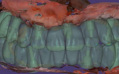 Teeth extraction and implantation for immediate loading
