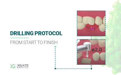 XGate Dental Implant Drilling Protocol Step-by-Step Guide