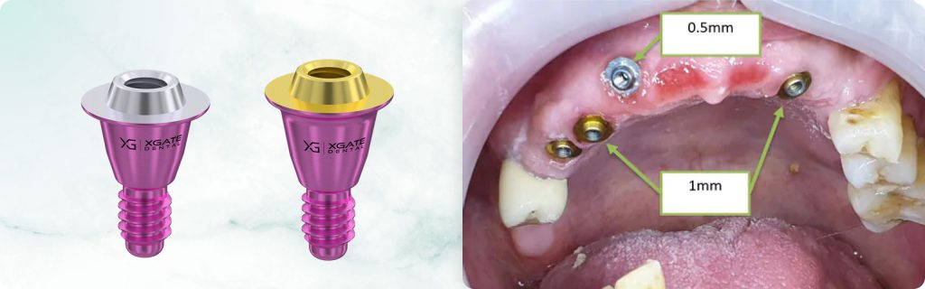 Use of an incorrectly placed implant by using Multi-Unit V-Type and 1.5mm sleeve