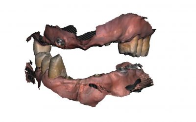 Use of an incorrectly placed implant by using Multi-Unit V-Type and 1.5mm sleeve