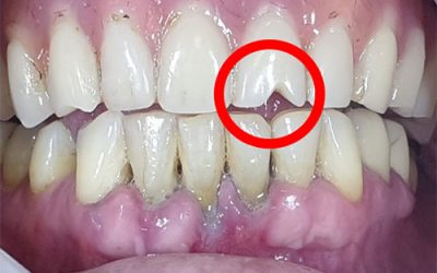 Immediate loading on the lower frontal teeth