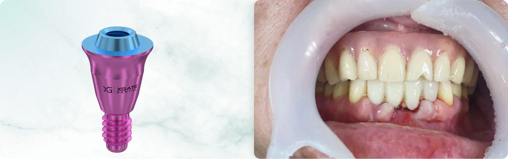 Immediate loading on the lower frontal teeth