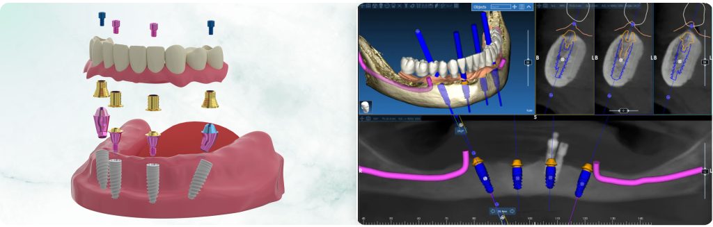 Immediate Full-Arch Restoration on 4/6 Implants. Part 1