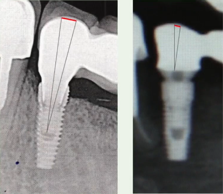 Comparison of framework deviation with screw retention directly to an implant versus to a multi-unit abutment (MUA): Using MUAs significantly lowers the likelihood of complications YouTube / Dr. Kamil Khabiev / Dental Guru Academy Comparison of framework deviation with screw retention directly to an implant versus to a multi-unit abutment (MUA): Using MUAs significantly lowers the likelihood of complications YouTube / Dr. Kamil Khabiev / Dental Guru Academy