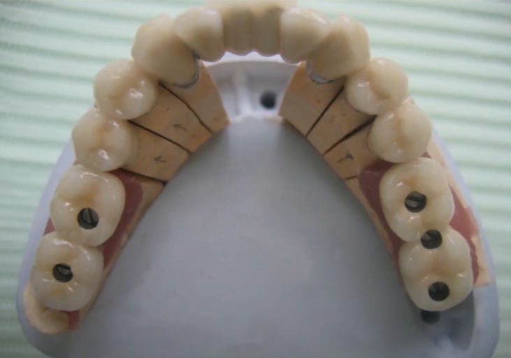Full-arch restoration on 5 implants, one of which is placed between the positions of the teeth 6 and 7 YouTube / Dr. Kamil Khabiev / Dental Guru Academy Full-arch restoration on 5 implants, one of which is placed between the positions of the teeth 6 and 7 YouTube / Dr. Kamil Khabiev / Dental Guru Academy