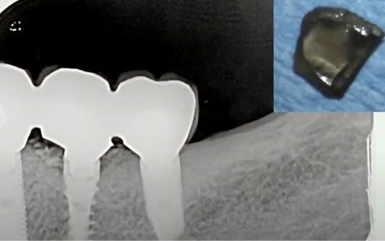 Implant fracture - requires removal and replacement YouTube / Dr. Kamil Khabiev / Dental Guru Academy Implant fracture - requires removal and replacement YouTube / Dr. Kamil Khabiev / Dental Guru Academy
