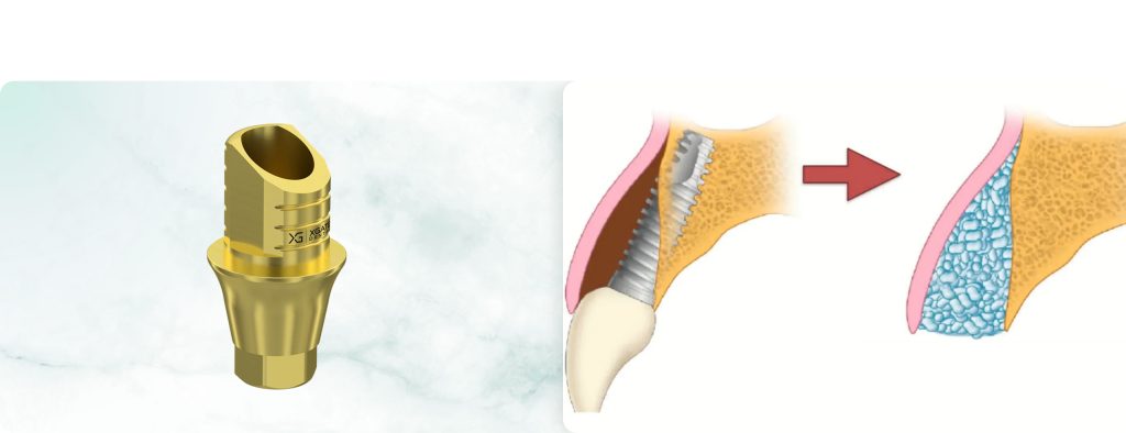 Immediate Implant Prosthetics: Risk Assessment and Clinical Protocols