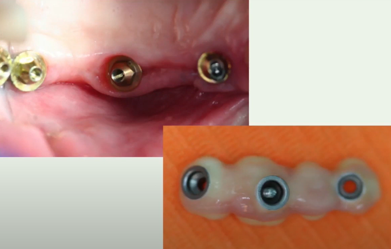 Screw-retained bridge on MUAs, compensating for significant implant angulation YouTube / Dr. Kamil Khabiev / Dental Guru Academy Screw-retained bridge on MUAs, compensating for significant implant angulation YouTube / Dr. Kamil Khabiev / Dental Guru Academy