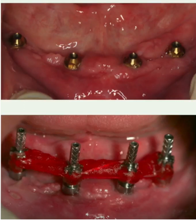 Screw retention on multi-unit abutments