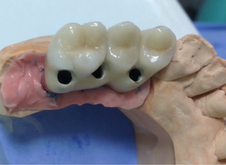 Screw retention supported by implants placed too palatally YouTube / Dr. Kamil Khabiev / Dental Guru Academy Screw retention supported by implants placed too palatally YouTube / Dr. Kamil Khabiev / Dental Guru Academy
