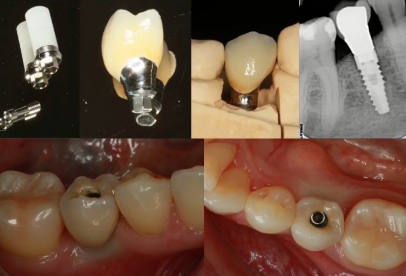 Single restoration at different stages of fabrication and fitting - contact point between premolar and prosthesis YouTube / Dr. Kamil Khabiev / Dental Guru Academy Single restoration at different stages of fabrication and fitting - contact point between premolar and prosthesis YouTube / Dr. Kamil Khabiev / Dental Guru Academy