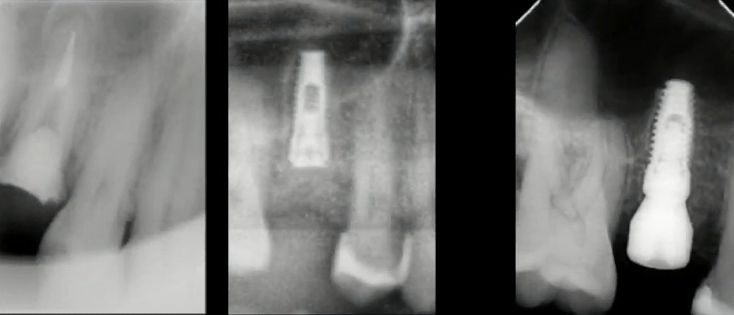 Apical anchoring of the implant