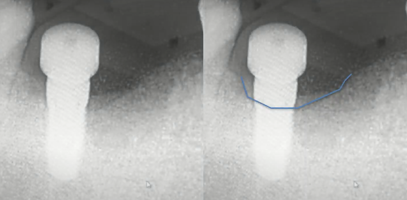Results of bone resorption around the implant neck
