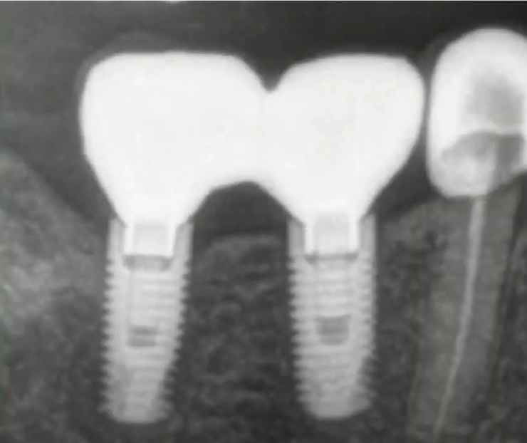 There are two bridges with screw retention and in both cases there are visible problems with the fit; there are noticeable gaps in between the internal hex and the implant body YouTube / Dr. Kamil Khabiev / Dental Guru Academy
