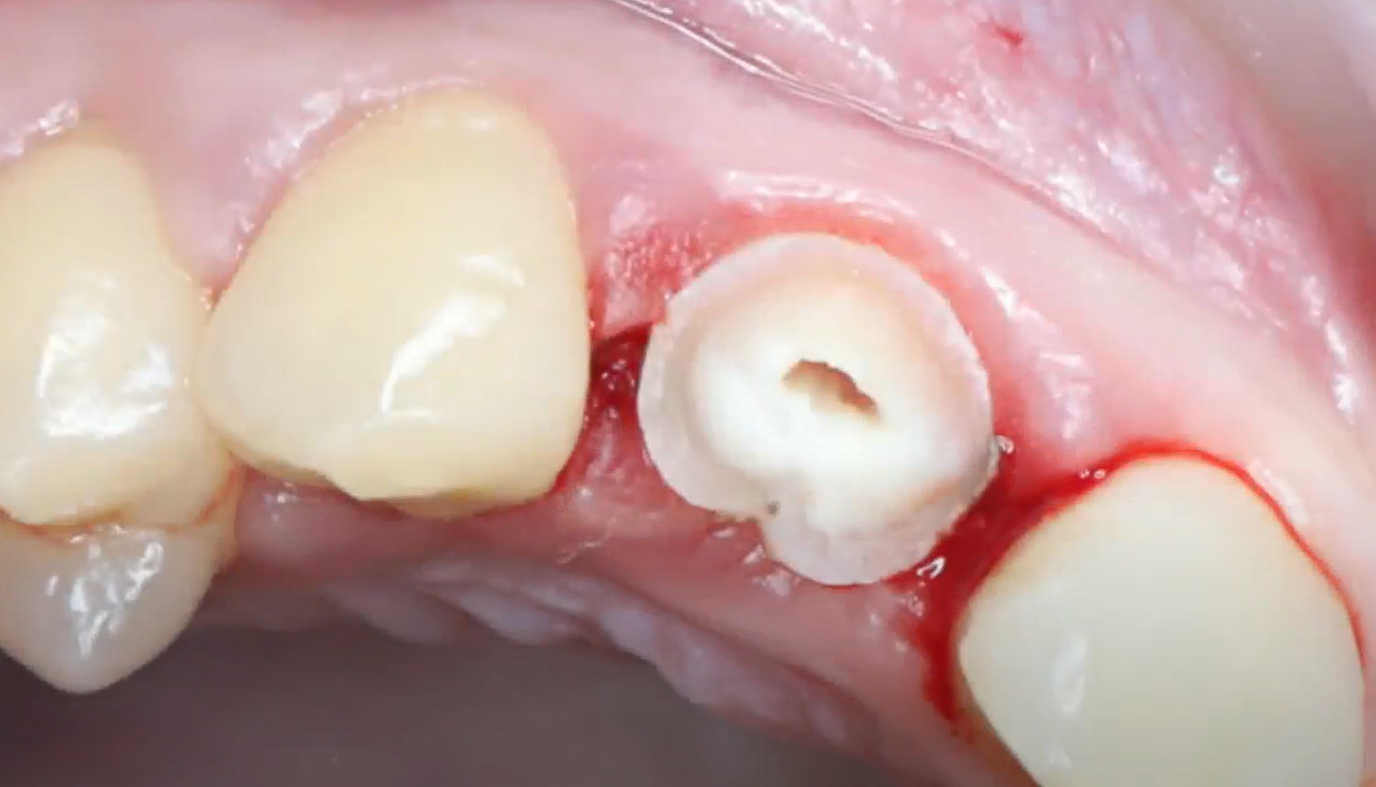 The first stage of removal is to cut off the crown part of the problem tooth