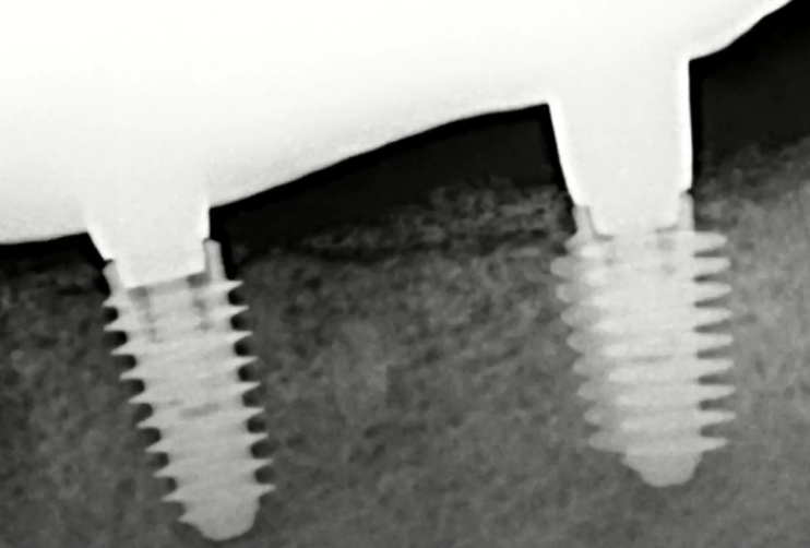 The dental technician ground down part of the interface (internal hex), otherwise the restoration would not fit YouTube/Dr. Kamil Khabiev / Dental Guru Academy The dental technician ground down part of the interface (internal hex), otherwise the restoration would not fit YouTube/Dr. Kamil Khabiev / Dental Guru Academy
