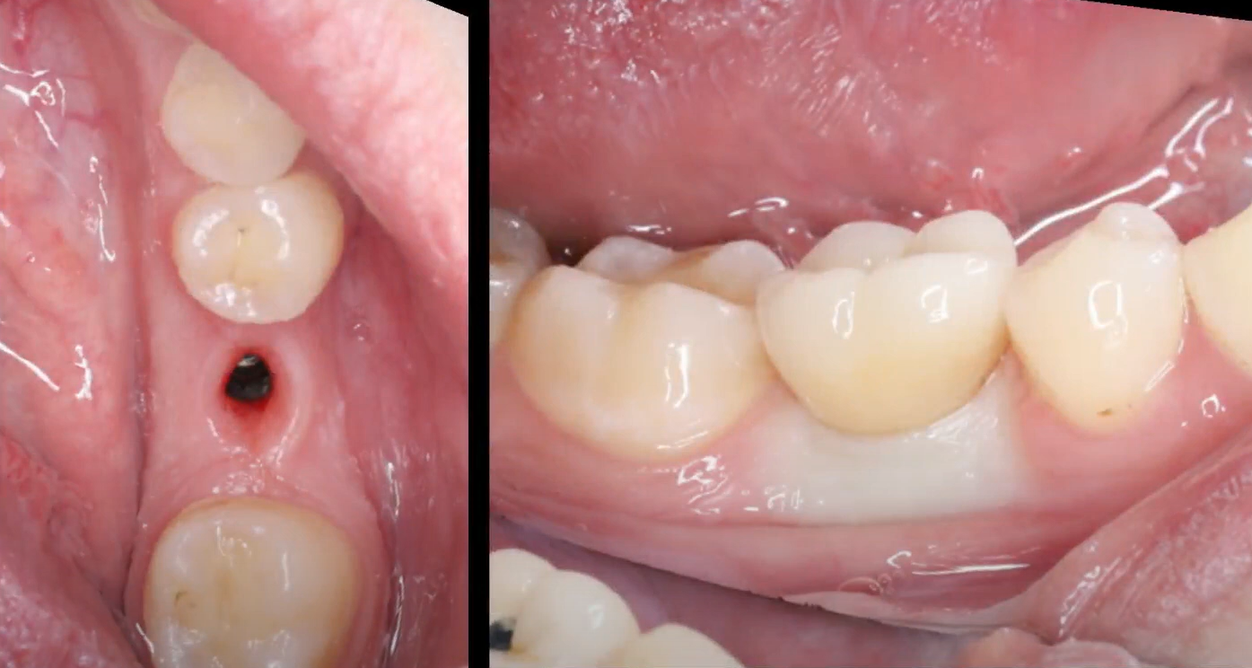 Unsuccessfully formed gingival cuff