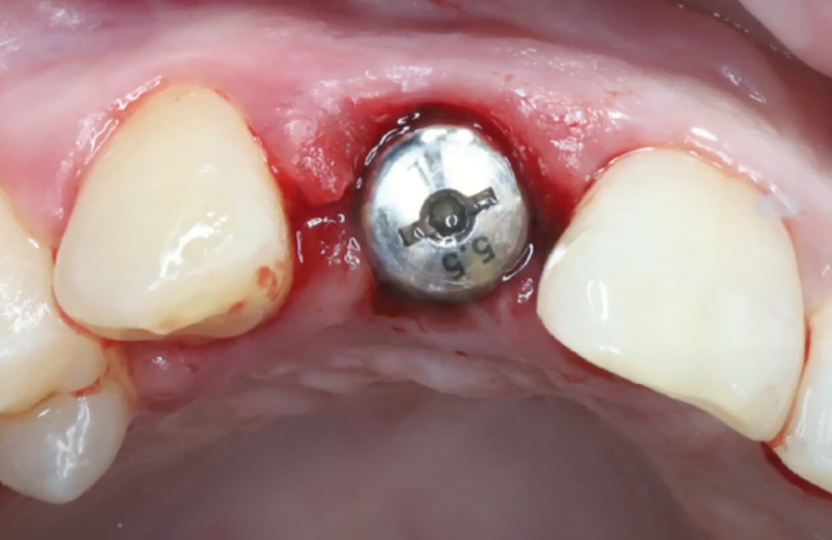 A temporary prosthesis is made from the coronal part of an extracted tooth