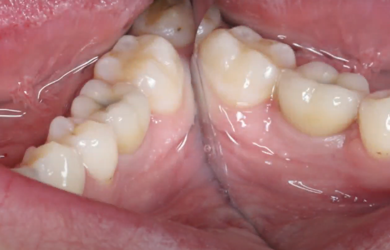 Healthy gum around the crown restoration