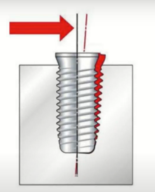 Implant displacement under the influence of external forces
