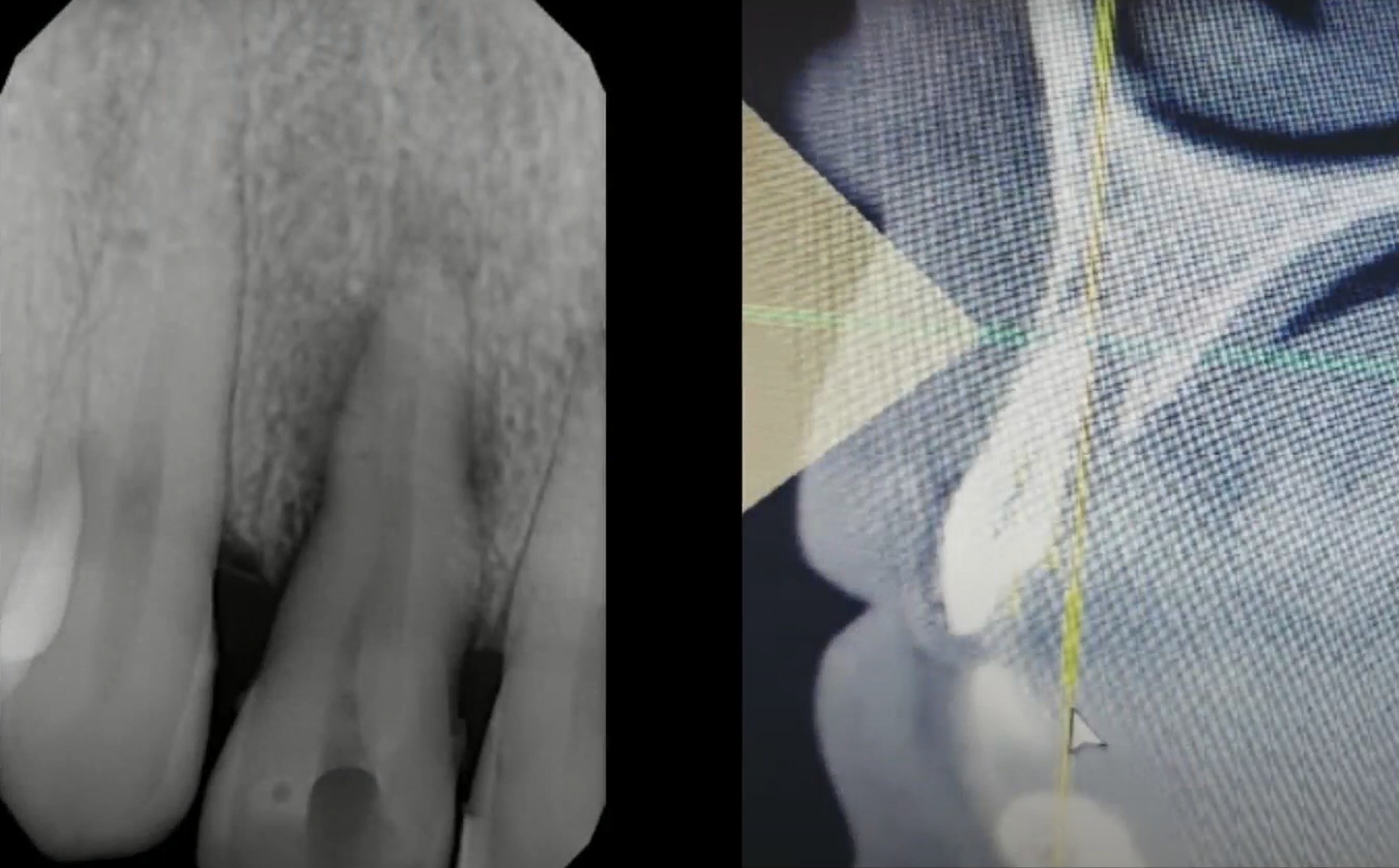 Initial situation: luxation of the tooth root