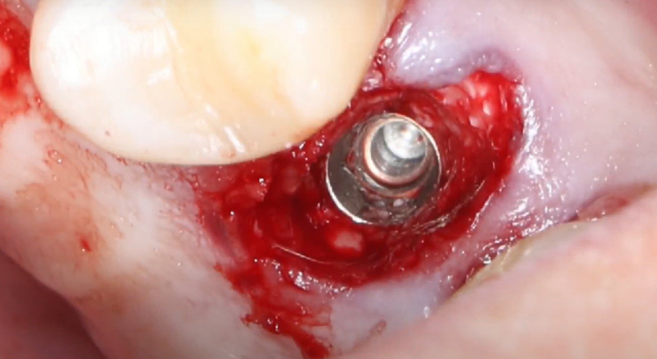 mplant 4.0x10 mm with interproximal anchoring
