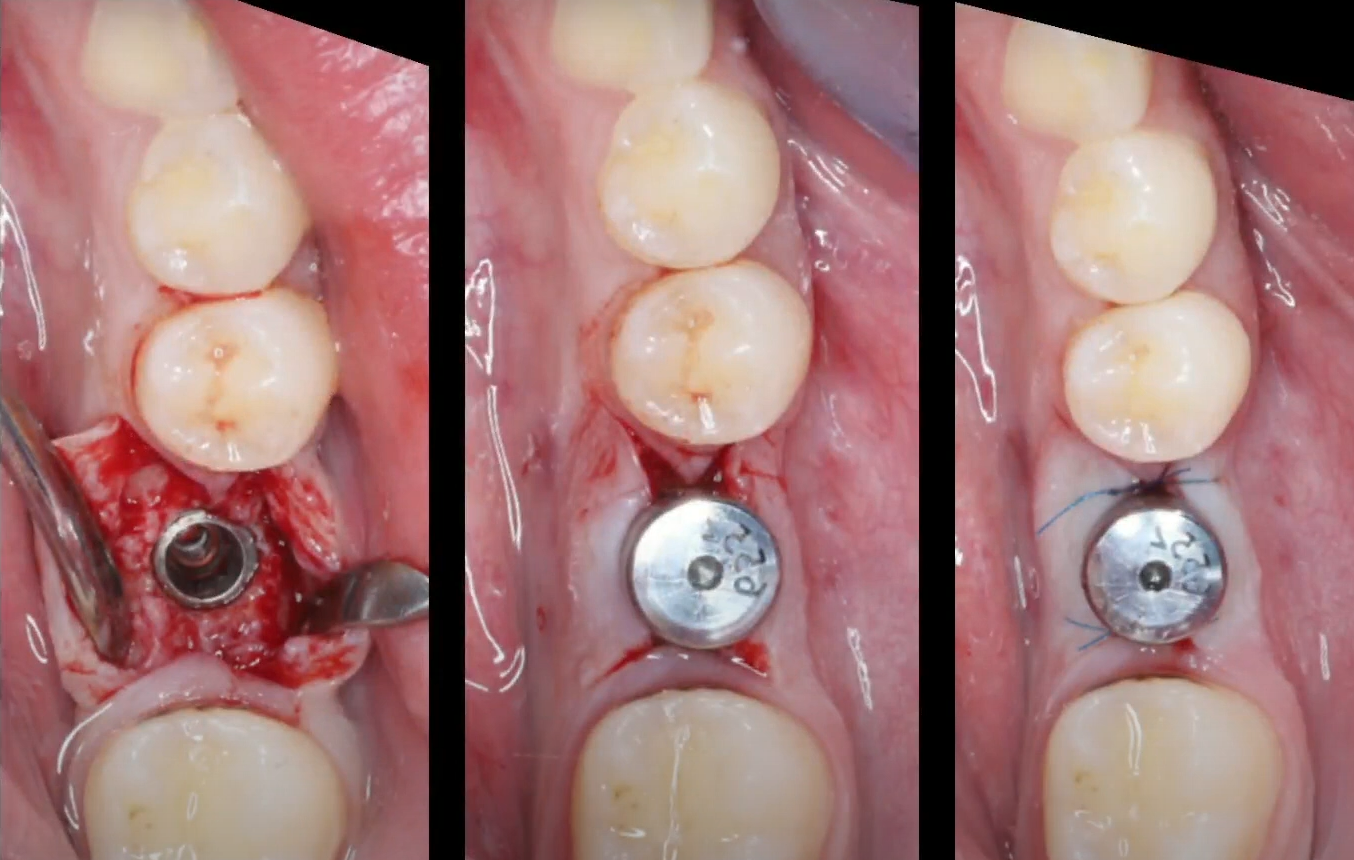 One-stage implantation protocol