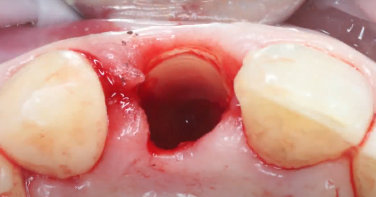 The buccal wall (shield), ready for further manipulation
