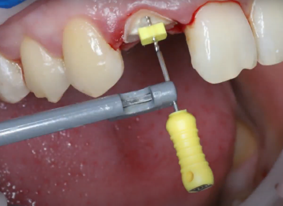 Measuring the depth of the root canal before removing part of the root