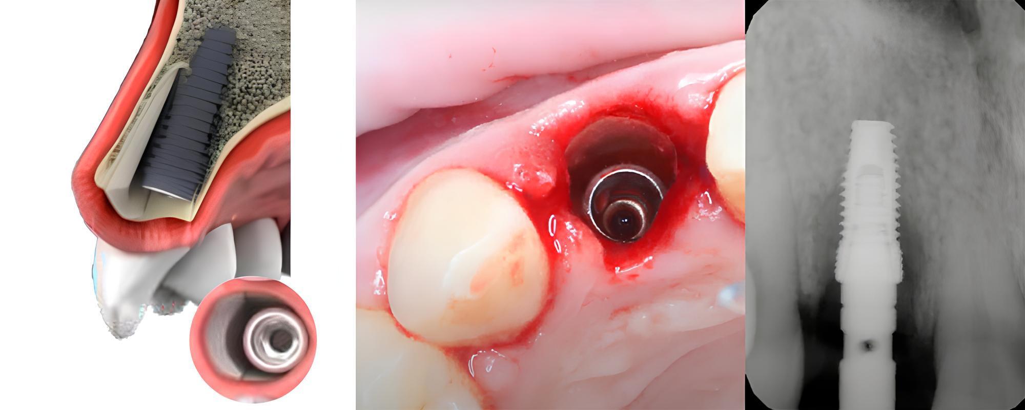 Placement of an implant using the Socket Shield method
