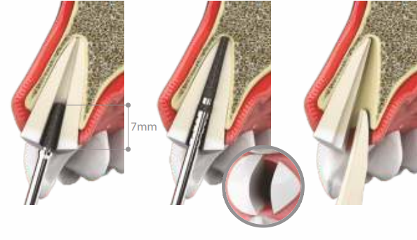 Recommendations of the standard implantation protocol using the Socket Shield technique