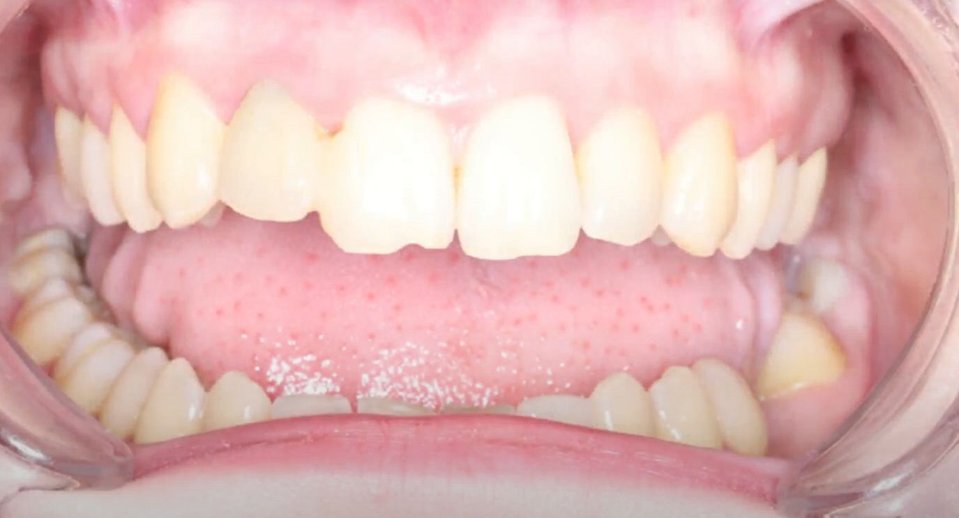 A temporary prosthesis is made from the coronal part of an extracted tooth