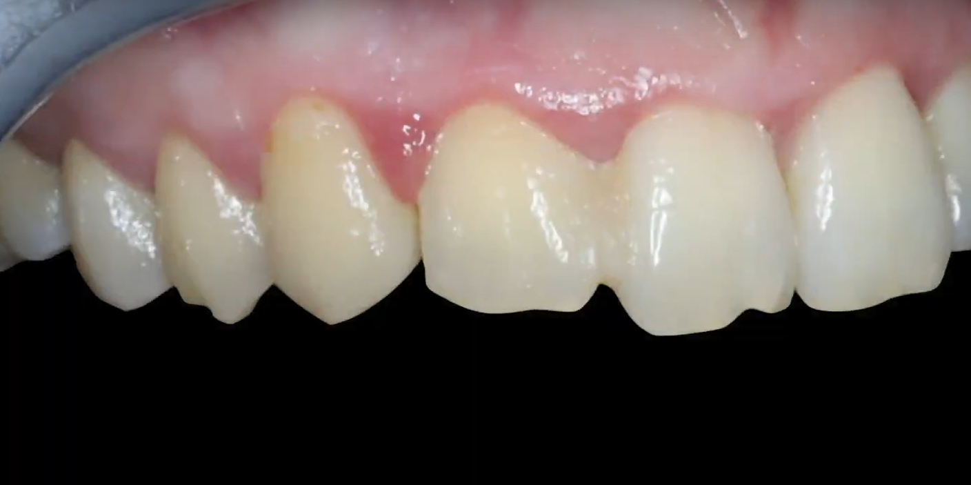 The problematic tooth is splinted with the adjacent tooth