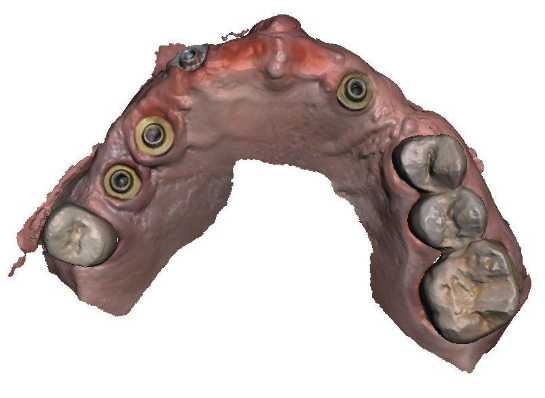3D model of the upper and lower jaw with installed MUA V-type