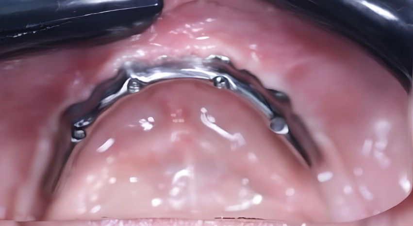 The titanium bar that supports the entire restoration