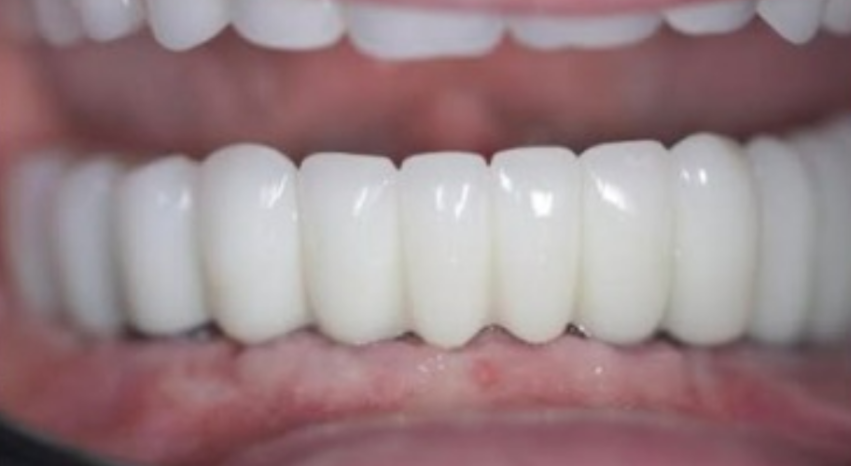 The restoration demonstrates an excellent aesthetic result