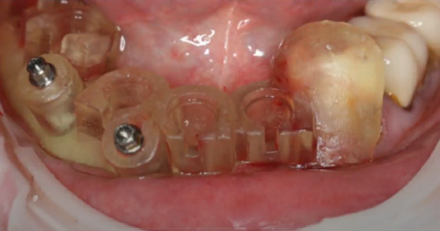 A digitally designed and 3D printed individual surgical template for precise positioning of implants including the position of the internal interface edgesYouTube / Dr. Kamil Khabiev / Dental Guru Academy