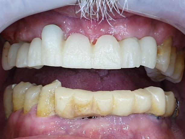 A finished zirconia dioxide upper jaw bridge with a protrusion opposite an irregularly positioned implant