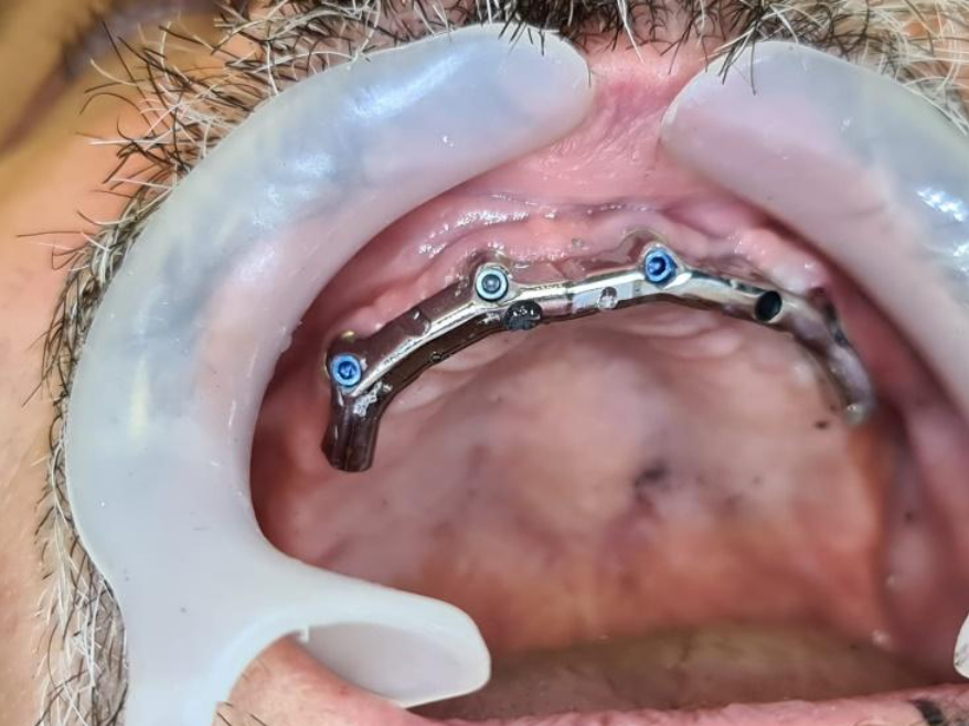 A fixed bar on which the removable denture will rest