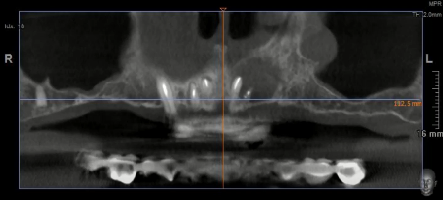A snapshot of the patient's initial situation - a large cyst rendering the anterior mandible unsuitable for implant placement YouTube / Dr. Kamil Khabiev / Dental Guru Academy