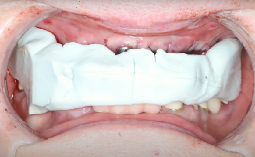 Bite registration after extraction and implant placement YouTube / Dr. Kamil Khabiev / Dental Guru Academy