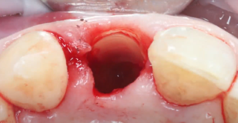 Buccal wall (shield) ready for further manipulations: color and condition of completely healthy tissue YouTube / Dr. Kamil Khabiev / Dental Guru Academy