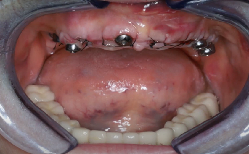 Condition of soft tissue before placement of the temporary prosthesis YouTube / Dr. Kamil Khabiev / Dental Guru Academy