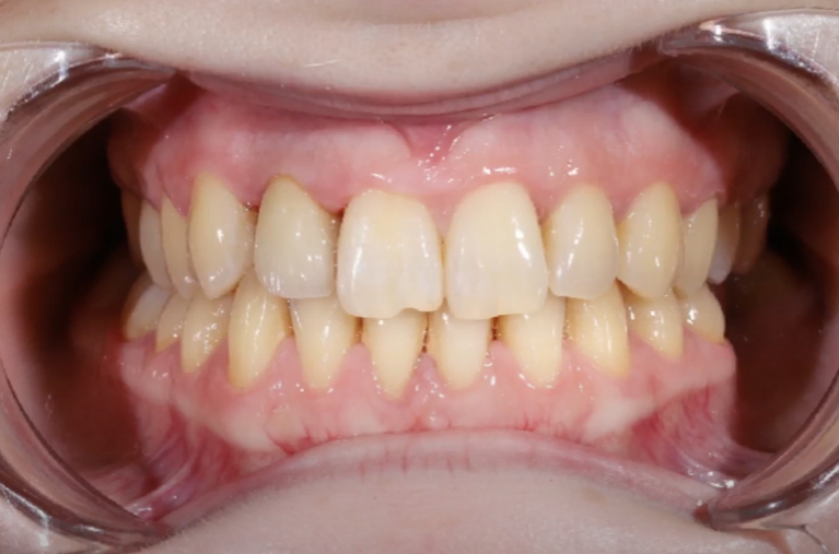 Definitive crown on tooth #12 - excellent functional and aesthetic outcome YouTube / Dr. Kamil Khabiev / Dental Guru Academy