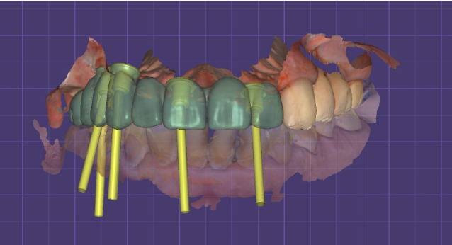 Development of a prosthesis in a digital environment