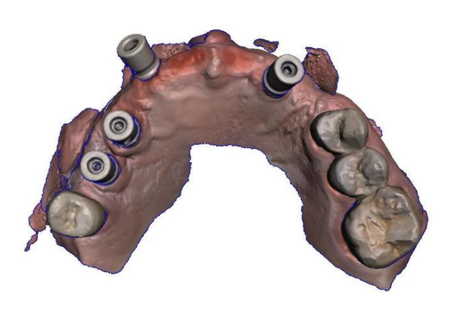 Digital impression of the patient's upper jaw made with an intraoral scanner